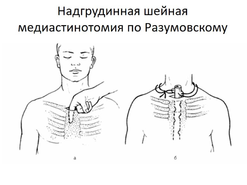 Надгрудинная шейная медиастинотомия по Разумовскому